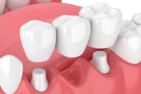 Underwood Dental Bridges