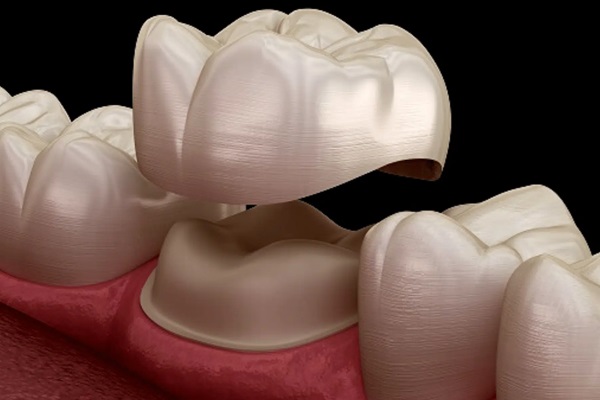 Underwood Dental Crowns