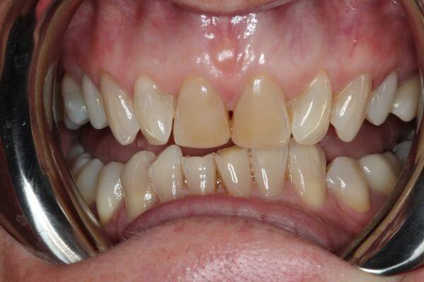 Porcelain Veneers My Dental Home