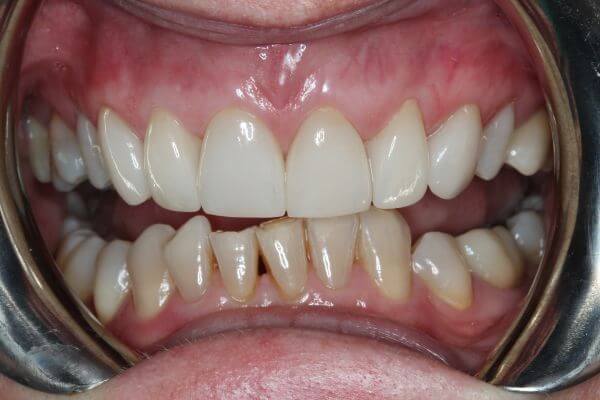 Porcelain Veneers My Dental Home