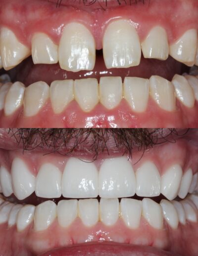 Composite Veneers