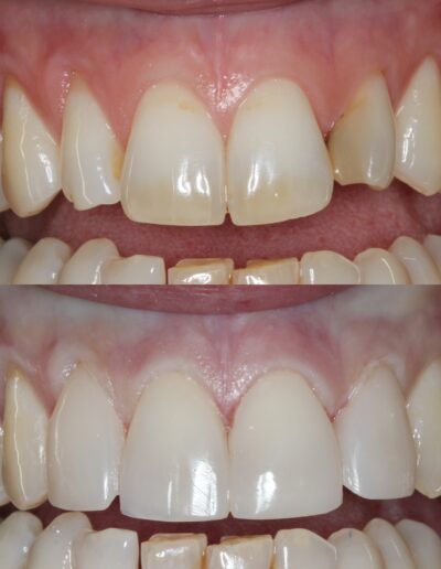 Composite Veneers