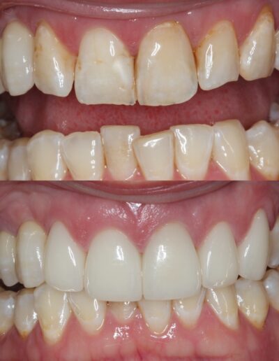 Composite Veneers