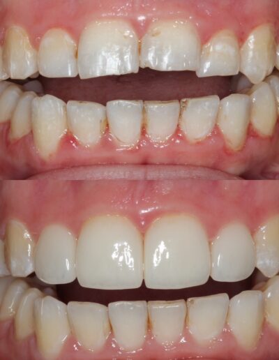 Composite Veneers