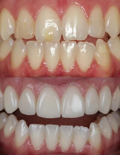 Composite Veneers