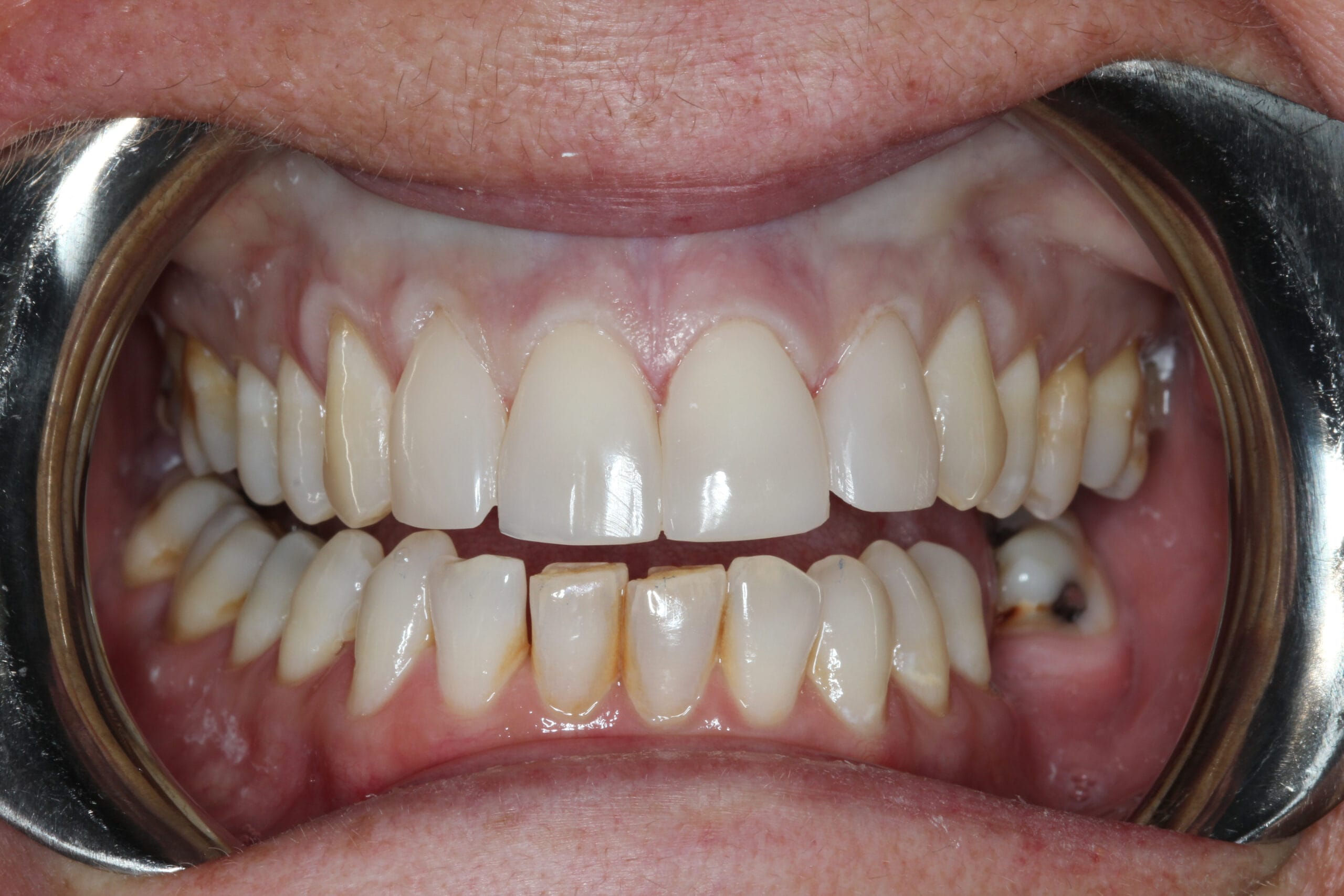 Composite and Resin Bonding My Dental Home