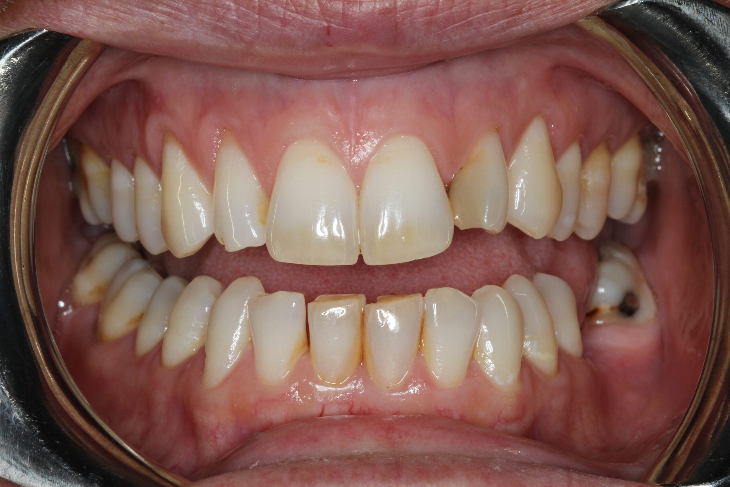 Composite and Resin Bonding My Dental Home